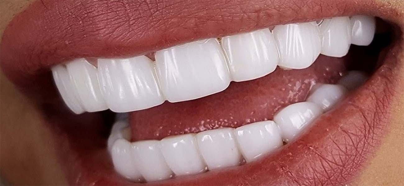 کامپوزیت دندان چیست ؟