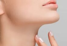 نقاهت ساکشن غبغب