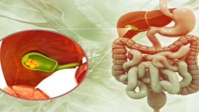 جراحی کیسه صفرا