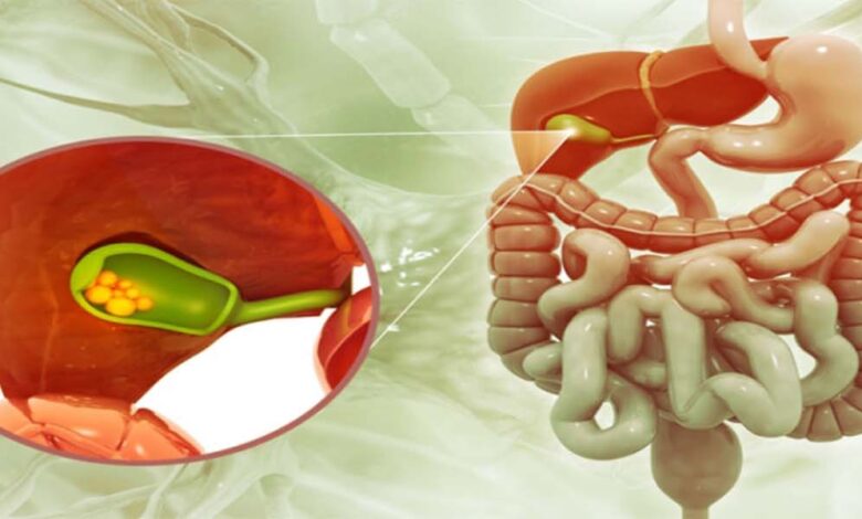 جراحی کیسه صفرا