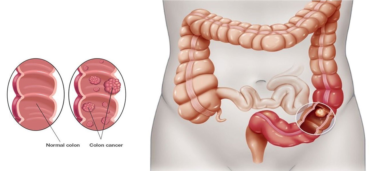 جراحی رکتوم