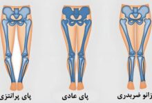 درمان زانوی پرانتزی