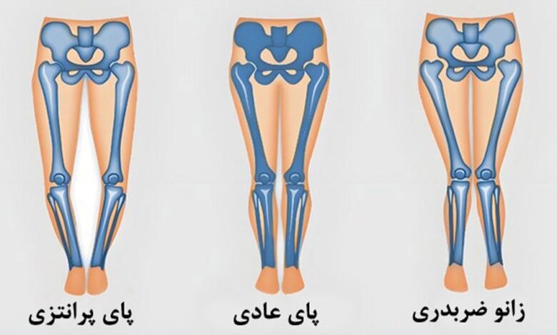 درمان زانوی پرانتزی