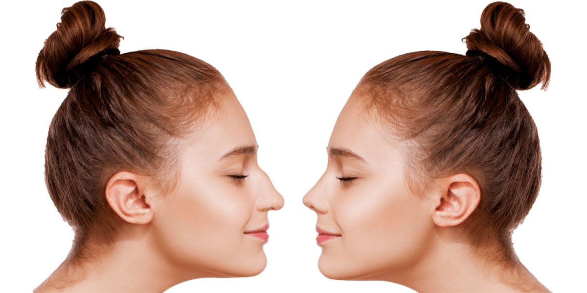 رینوپلاستی چیست ؟