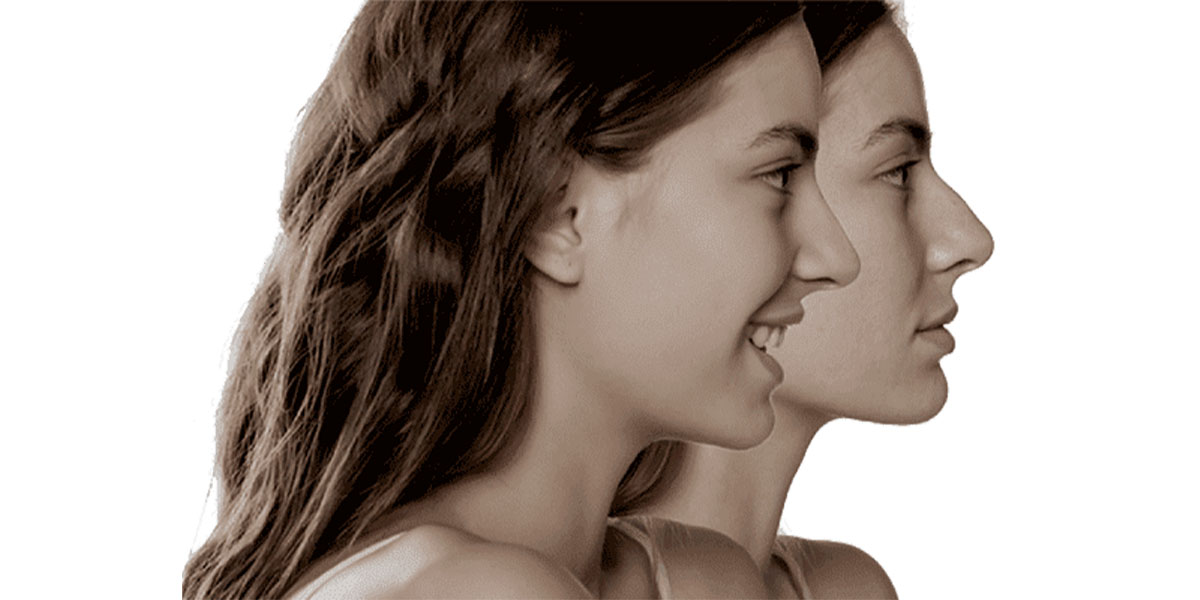 رینوپلاستی چیست ؟