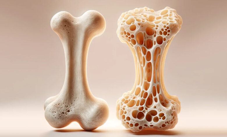 پوکی استخوان