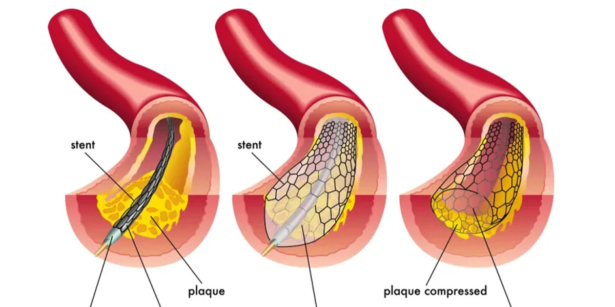 آنژیوپلاستی چیست ؟