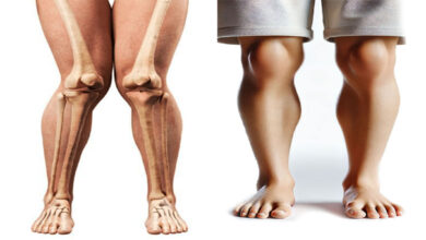 جراحی زانوی ضربدری