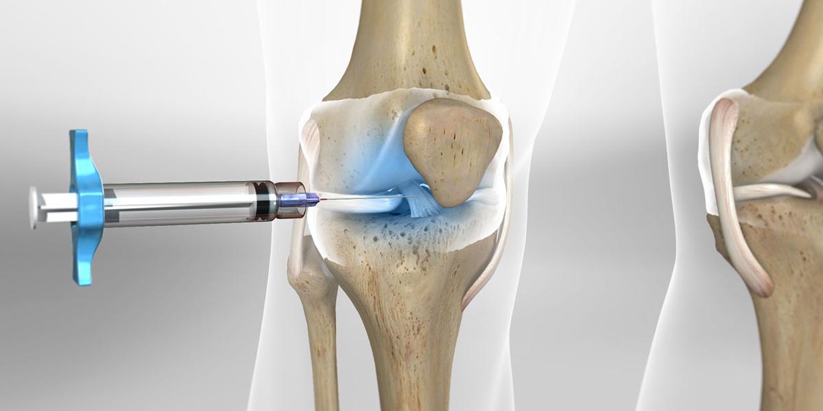 تزریق ژل به زانو