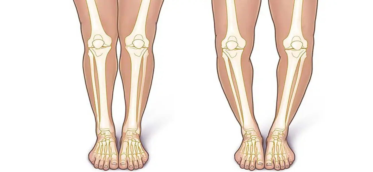 درمان زانوی پرانتزی