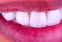 لمینت سرامیکی دندان چیست ؟