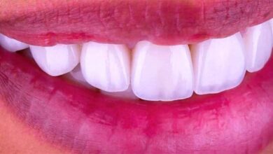 لمینت سرامیکی دندان چیست ؟