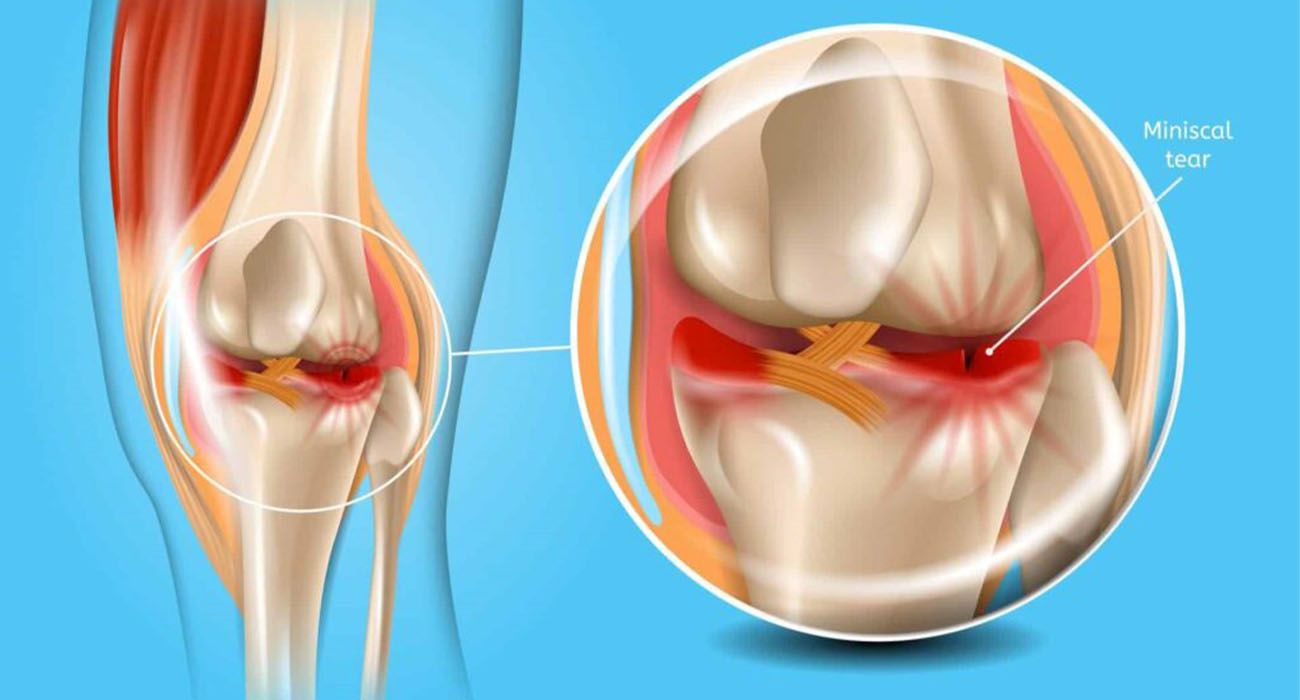پارگی مینیسک زانو