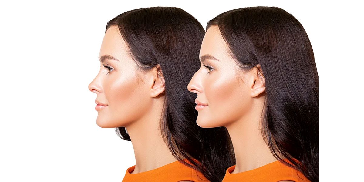 رینوپلاستی چیست ؟