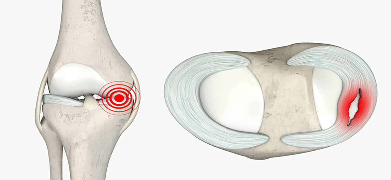 پارگی مینیسک زانو