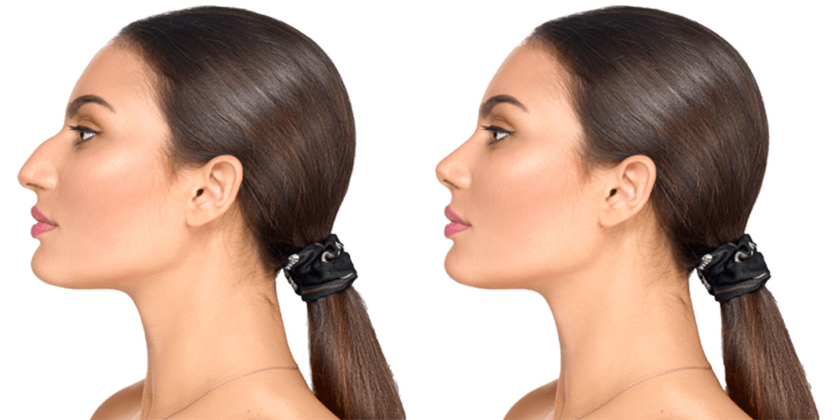 عمل بینی چند درصد در زیبایی تاثیر دارد؟