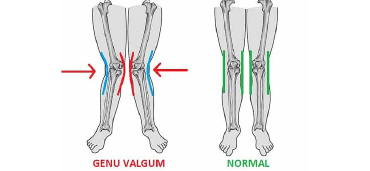 جراحی زانوی ضربدری