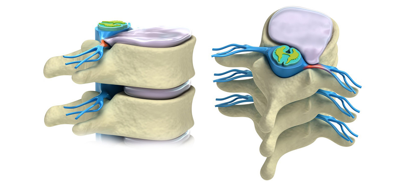 درمان غیر جراحی دیسک کمر