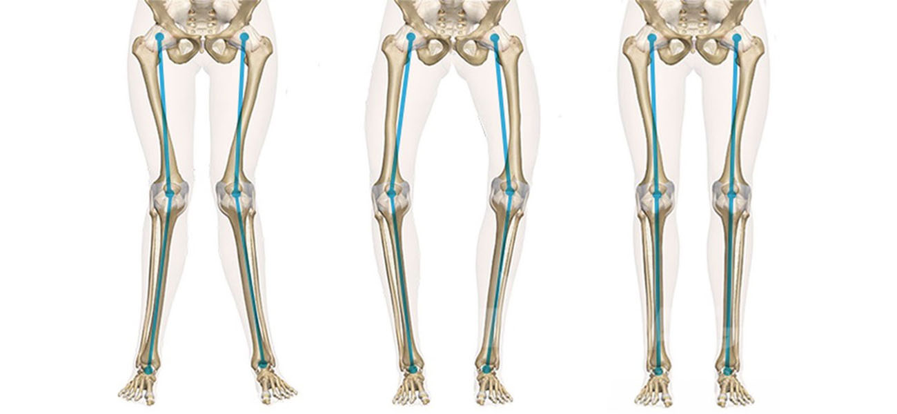 درمان زانوی پرانتزی