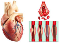 آنژیوپلاستی چیست ؟