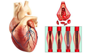 آنژیوپلاستی چیست ؟