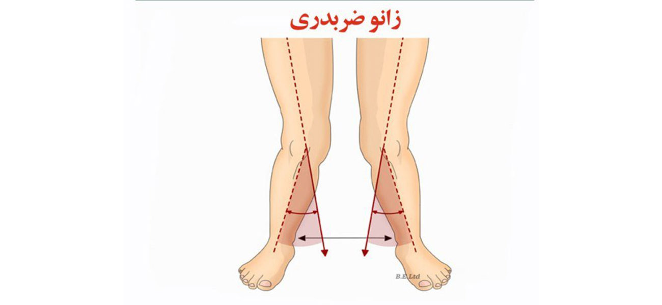 جراحی زانوی ضربدری
