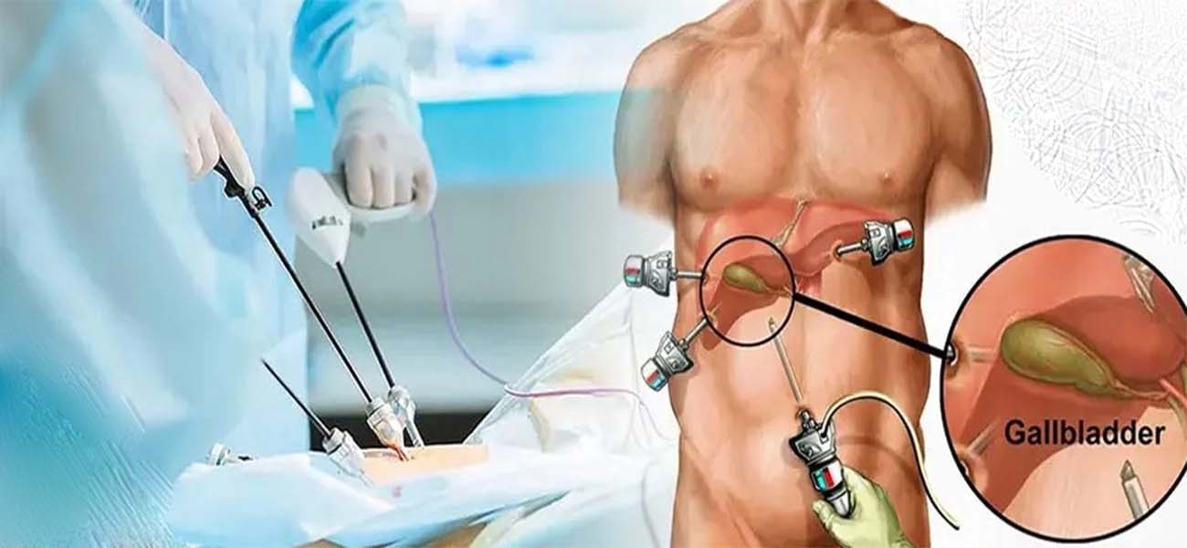 جراحی کیسه صفرا