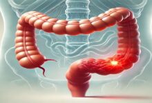 جراحی رکتوم